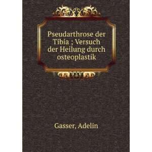  Tibia ; Versuch der Heilung durch osteoplastik Adelin Gasser Books