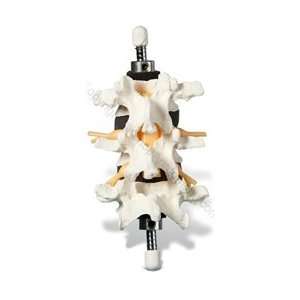  3 Lumbar Vertebrae Mounted on Flexible Rod (Made in USA 